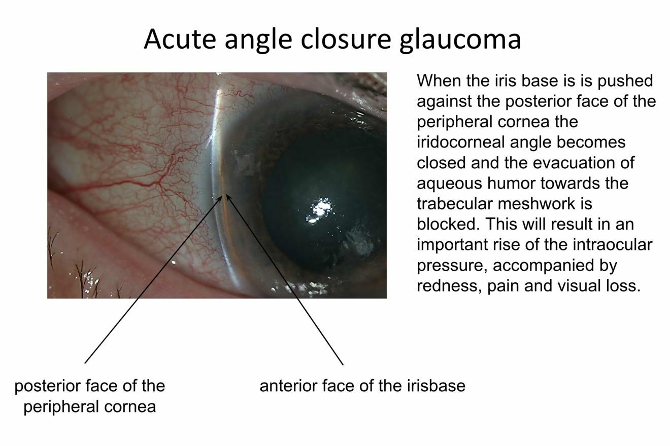 What is acute angle-closure glaucoma ?